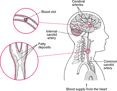 Ischemic Stroke